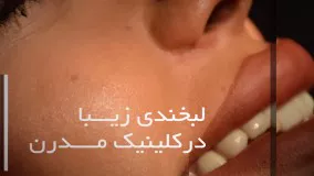 مراحل کاشت ایمپلنت دندان