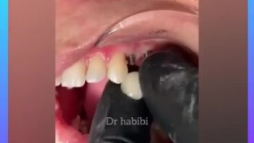 جراحی ایمپلنت