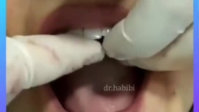 بعد از عمل ایمپلنت