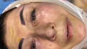 جراحی زیبایی صورت، بعد از عمل