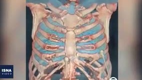 ریه فرد مبتلا به کرونا اینگونه می‌شود