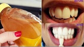 از بین بردن سریع زردی دندان با روش آسان و ارزان خانگی