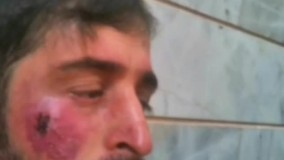 لوپوس چیست و چگونه درمانش کنیم؟