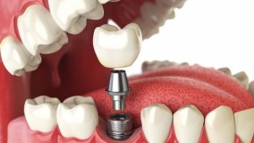 ایمپلنت دندان به روش آسان _ آموزش کاشت دندان