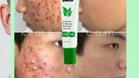 قیمت کرم ضد جوش فوری/09120132883 /کرم ضد جوش فوری