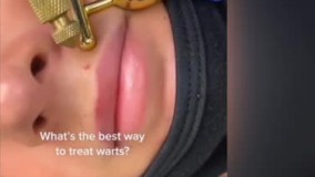 کرایو سرجری