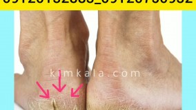 درمان ترک پاشنه پا/09120132883/کرم برای ترک پا