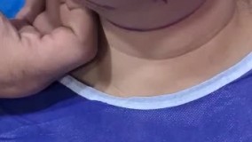 لیپو غبغب - قبل از عمل