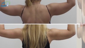 نتیجه عمل لیپوماتیک