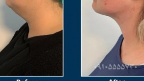 عمل جراحی زیبایی غبغب شیراز