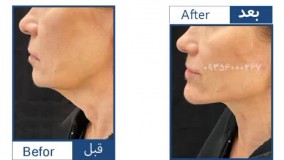 عمل جراحی زیبایی غبغب در مشهد