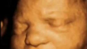 سونوگرافی چهار بعدی در بارداری هفته سی و چهارم