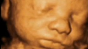 سونوگرافی چهار بعدی در بارداری هفته سی و یکم