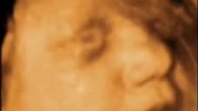 سونوگرافی چهار بعدی در بارداری هفته سی و دوم