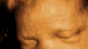 سونوگرافی چهار بعدی در بارداری هفته سی و پنجم