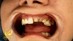 لمینت فول سرامیک در کلینیک دایا