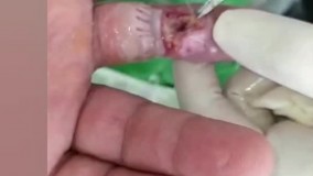 دبریدمان زخم دیابتی در کلینیک درمان زخم دیابتی در مشهد