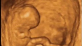 سونوگرافی چهار بعدی هفته هفتم بارداری