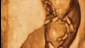 سونوگرافی چهار بعدی در بارداری هفته یازدهم - 2