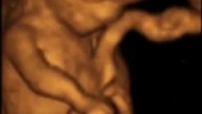 سونوگرافی چهار بعدی در بارداری هفته دهم - 2