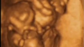 سونوگرافی چهار بعدی در بارداری هفته دهم - 1