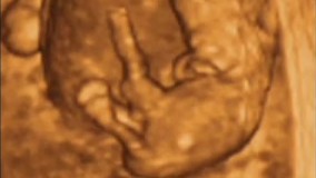 سونوگرافی چهار بعدی در بارداری هفته هشتم