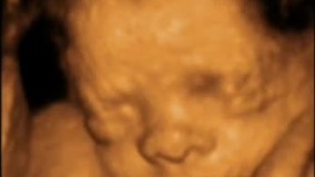 سونوگرافی چهار بعدی در بارداری هفته بیست و نهم