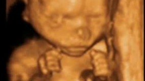 سونوگرافی چهار بعدی در بارداری هفته هجدهم