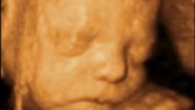 سونوگرافی چهار بعدی در بارداری هفته بیست و ششم