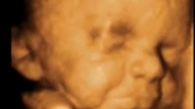 سونوگرافی چهار بعدی در بارداری هفته بیست و هشتم