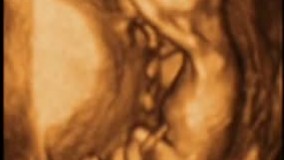 سونوگرافی چهار بعدی در بارداری هفته چهاردهم