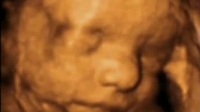 سونوگرافی چهار بعدی در بارداری هفته سی ام