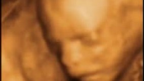 سونوگرافی چهار بعدی در بارداری هفته بیستم