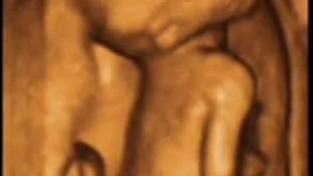 سونوگرافی چهار بعدی هفته پانزدهم بارداری