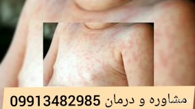 اولین درمان پسوریازیس