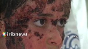 کودک فداکار با تلاش پزشکان شیرازی درمان و از بیمارستان مرخص شد