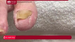 پدیکور - آموزش پدیکور پاهای آسیب دیده