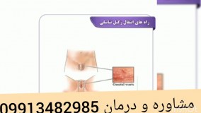 جدیدترین و موثرترین داروی زگیل تناسلی