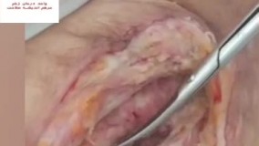 آموزش درمان آبسه در محل زخم انجام پیوند کلیه