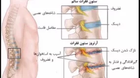 درمان قطعی روماتیسم مفصلی و آرتروز