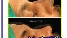 عمل  جراحی زیبایی بینی در مشهد