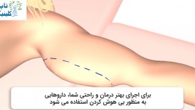چگونگی انجام عمل لیپوماتیک بازو
