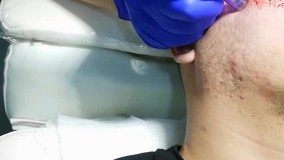 انجام تیکسل جهت رفع جای جوش صورت تحت نظرمتخصص پوست خانم دکترناهید همتیان