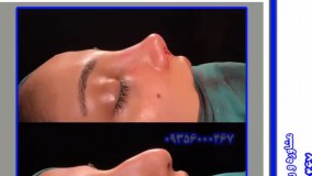 عمل  جراحی زیبایی بینی