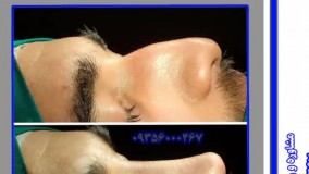 عمل جراحی قبل وبعد بینی