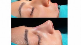 عمل  زیبایی بینی در مشهد