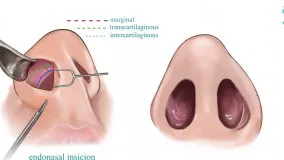 مراحل انجام عمل زیبایی بینی به طور کامل