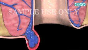 سوالات درباره بیماری هموروئید