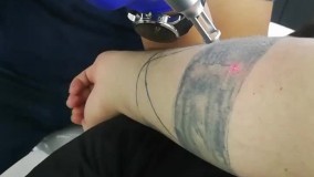 حذف (ریمو) تتو بابهترین دستگاه درکلینیک تخصصی جُوان تحت نظر متخصص پوست مو وزیبایی دکتر ناهیدهمتیان