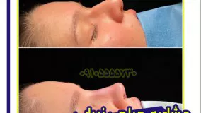 عمل  جراحی زیبایی بینی